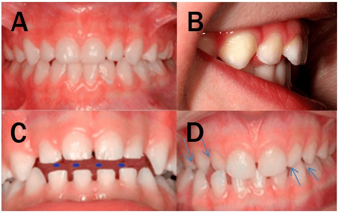 Utilização da chupeta e alteração dos dentes